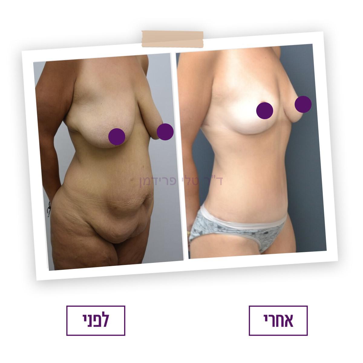 ניתוח מתיחת בטן - לפני ואחרי